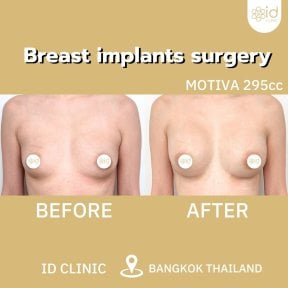 Before and after breast augmentation results at ID Clinic Bangkok with Motiva 295cc implants