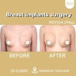 Before and after breast augmentation results at ID Clinic Bangkok with Motiva 295cc implants