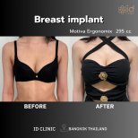 Before and after breast augmentation results at ID Clinic Bangkok with Motiva Ergonomix implants