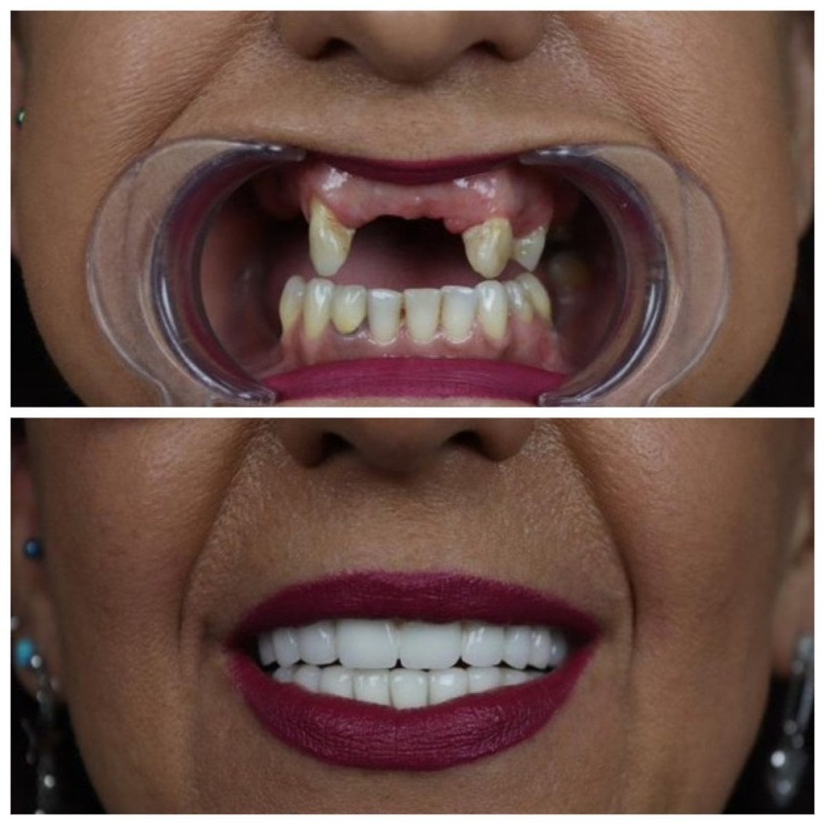 نتائج قبل وبعد زراعة الأسنان All-on-4 في يوم واحد في عيادة TH Dental، استعادة الابتسامة