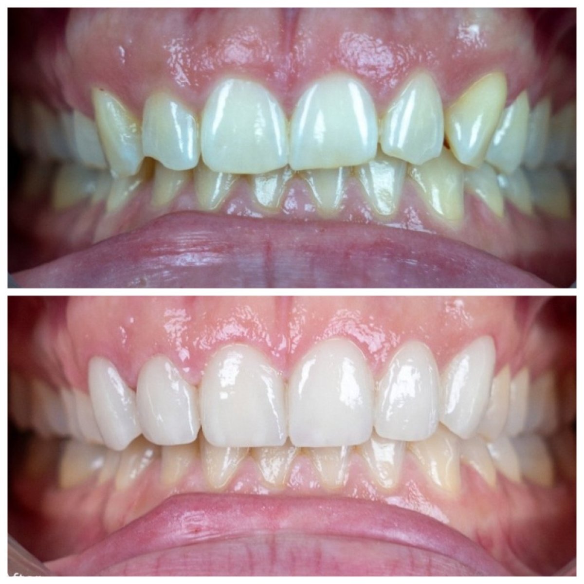 Resultados antes y después de carillas de porcelana en TH Dental Clinic – sonrisa mejorada