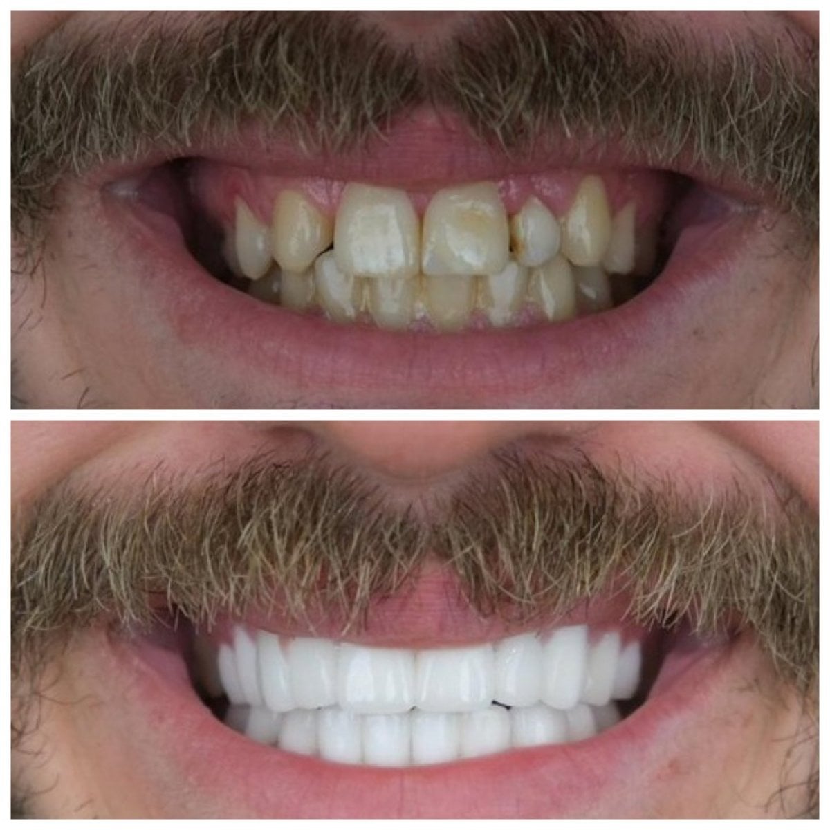 Resultados de antes y después de smile makeover en TH Dental Clinic: alineación y color mejorados
