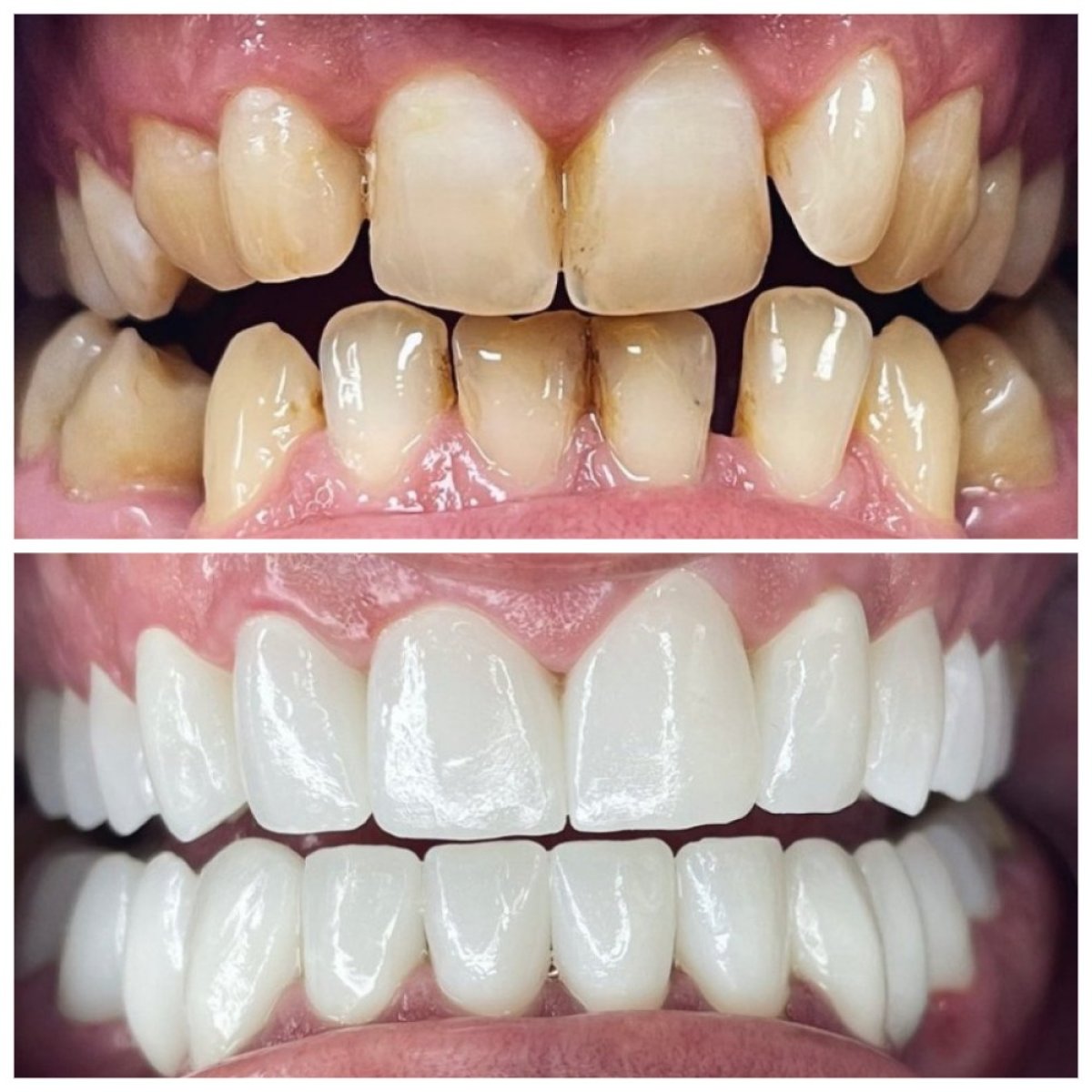 نتائج قبل وبعد الفينير في TH Dental Clinic – تحول الابتسامة بأسنان بيضاء ومتناسقة