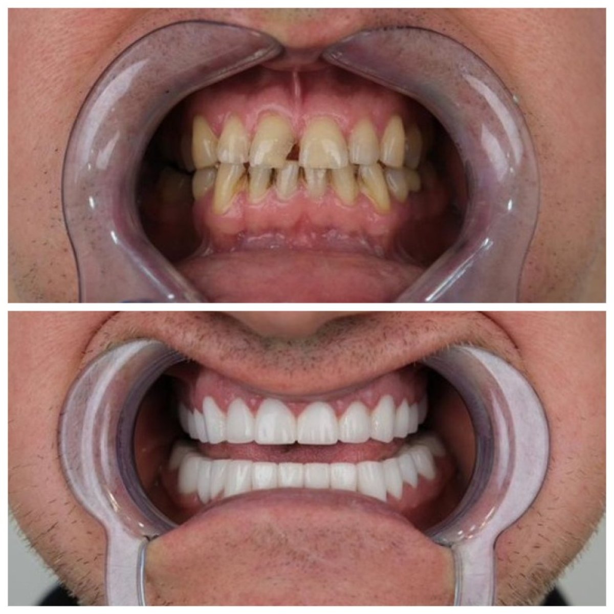 Antes y después de smile makeover en TH Dental Clinic – carillas dentales para dientes blancos y parejos