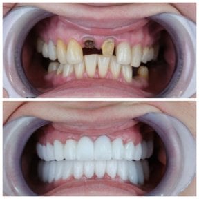 before-after photo zirconia-crown-installation