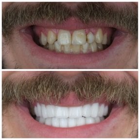 before-after photo zirconia-crown-installation