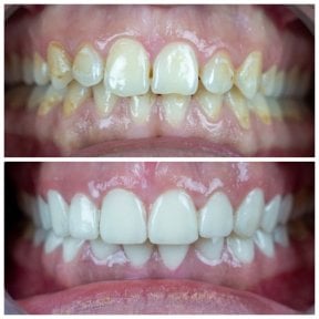 before-after photo zirconia-crown-installation