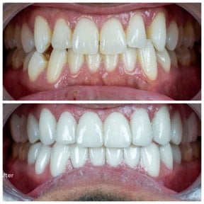 before-after photo zirconia-crown-installation