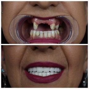 before-after photo zirconia-crown-installation