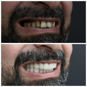 before-after photo zirconia-crown-installation