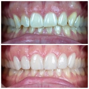 before-after photo zirconia-crown-installation