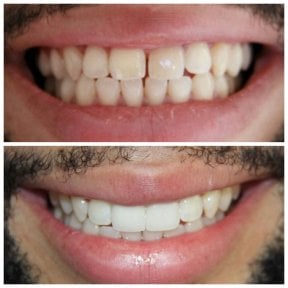 before-after photo zirconia-crown-installation