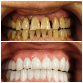before-after photo zirconia-crown-installation