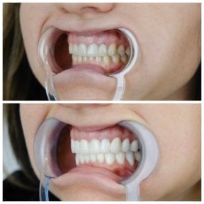 before-after photo zirconia-crown-installation