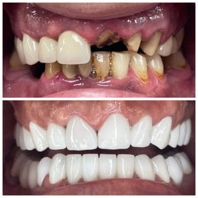 before-after photo dental-implant