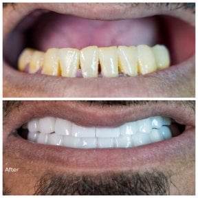 before-after photo dental-implant