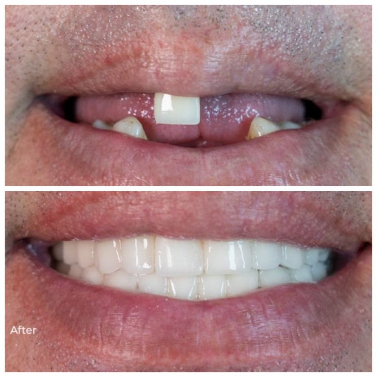 Resultados antes y después de implantes dentales en TH Dental Clinic – sonrisa restaurada