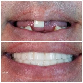 before-after photo dental-implant