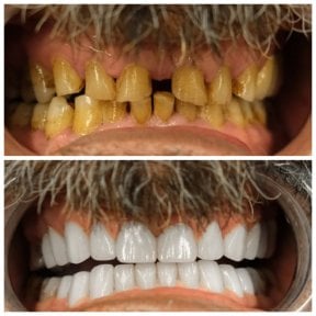 before-after photo dental-implant