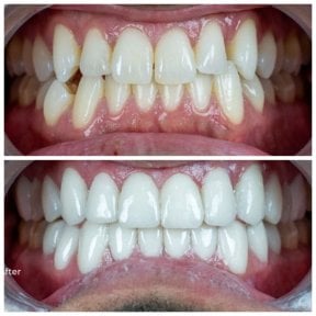 before-after photo hollywood-smile