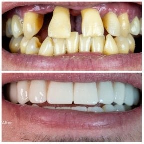 before-after photo hollywood-smile