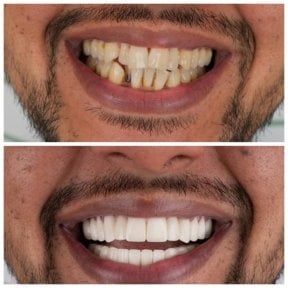before-after photo hollywood-smile
