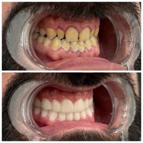 before-after photo hollywood-smile
