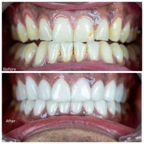 before-after photo hollywood-smile