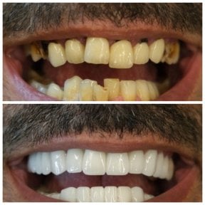 before-after photo hollywood-smile