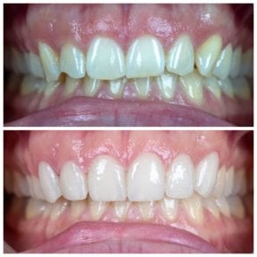 before-after photo hollywood-smile