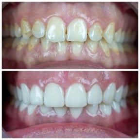 before-after photo hollywood-smile