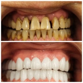 before-after photo hollywood-smile
