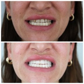 before-after photo hollywood-smile