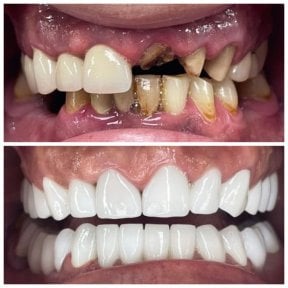 before-after photo all-on-6-dental-implants