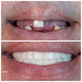 before-after photo all-on-6-dental-implants