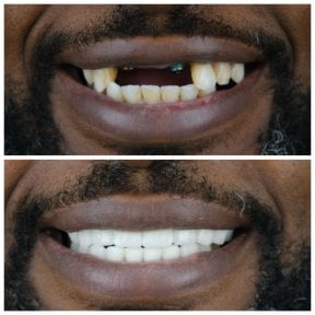 before-after photo all-on-6-dental-implants