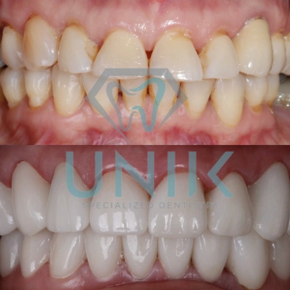 نتائج قبل وبعد تجميل الابتسامة بالفينير في عيادة Unik Specialized Dentistry