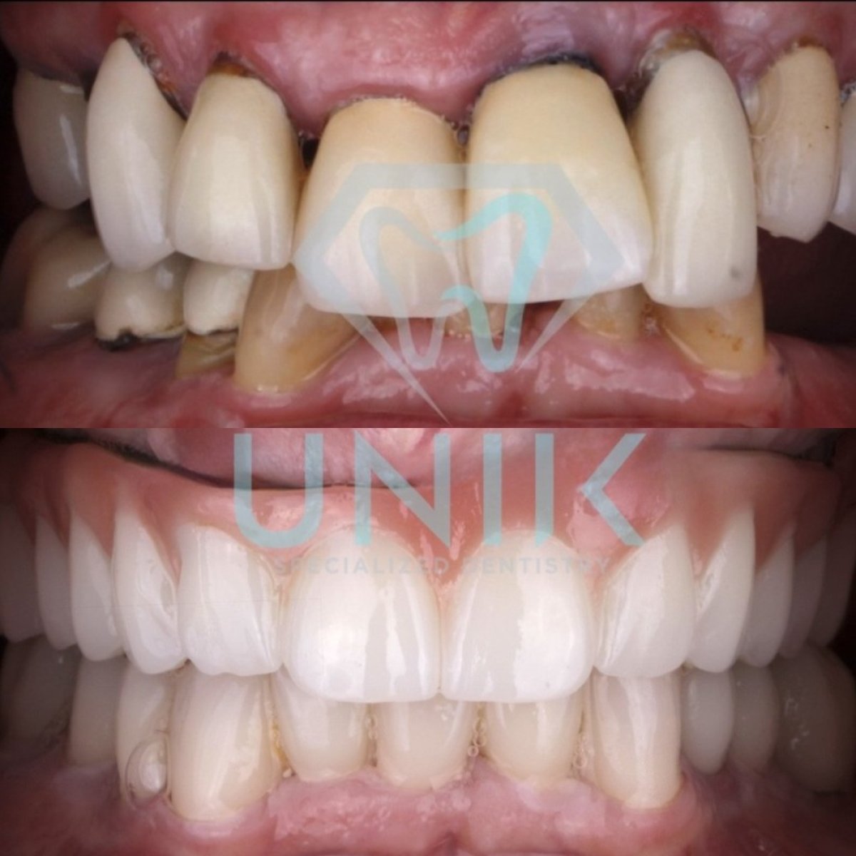 نتائج قبل وبعد جسر الزرع في عيادة Unik Specialized Dentistry، ابتسامة طبيعية مستعادة