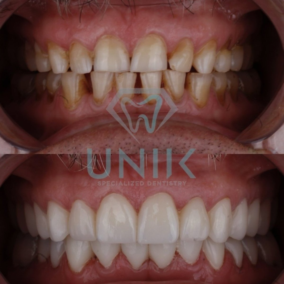 Antes y después de carillas dentales en Unik Specialized Dentistry – resultado de sonrisa transformada