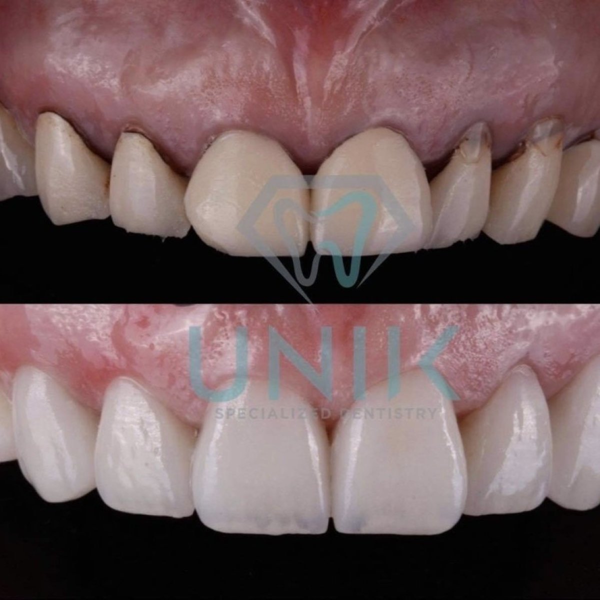 نتائج قبل وبعد الفينير في عيادة Unik Specialized Dentistry – ابتسامة محسنة وأسنان أكثر بياضاً