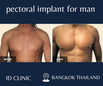 Before and after pectoral implant for men at ID Clinic Bangkok, enhanced chest contour result