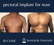 Before and after pectoral implant for men at ID Clinic Bangkok, enhanced chest contour result