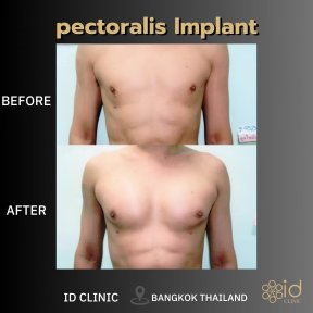 Before and after pectoral implant results at ID Clinic Bangkok, enhanced chest contour