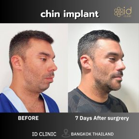 Before and after chin implant results at ID Clinic Bangkok, improved chin profile visible