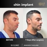 Before and after chin implant results at ID Clinic Bangkok, improved chin profile visible