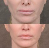 Résultats avant/après lip lift chez Dr. Alexandro Aguilera - Plastic Surgery, contour des lèvres amélioré