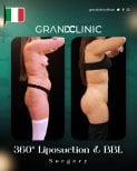 Before and after 360 liposuction and Brazilian Butt Lift results at Grand Clinic
