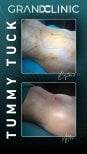 Before and after tummy tuck results at Grand Clinic – visible abdominal contour improvement