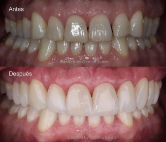 نتيجة قبل وبعد زراعة الأسنان All-on-6 في Dentica by Cristina Suaza، استعادة الابتسامة