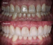 نتيجة قبل وبعد زراعة الأسنان All-on-6 في Dentica by Cristina Suaza، استعادة الابتسامة